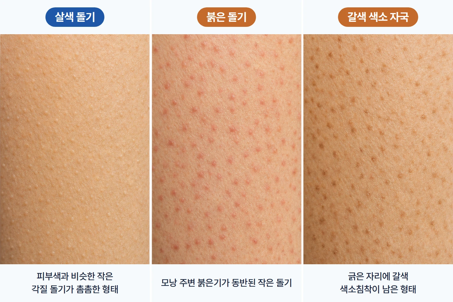 모낭 입구에 각질이 쌓여 입구를 막고 작은 돌기가 형성되는 과정