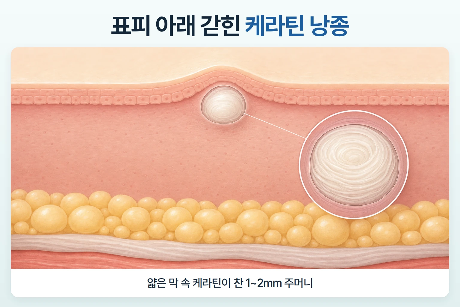 표피 바로 아래 얇은 막 속에 케라틴이 단단히 찬 작은 얼굴 비립종 주머니를 그린 피부 단면도