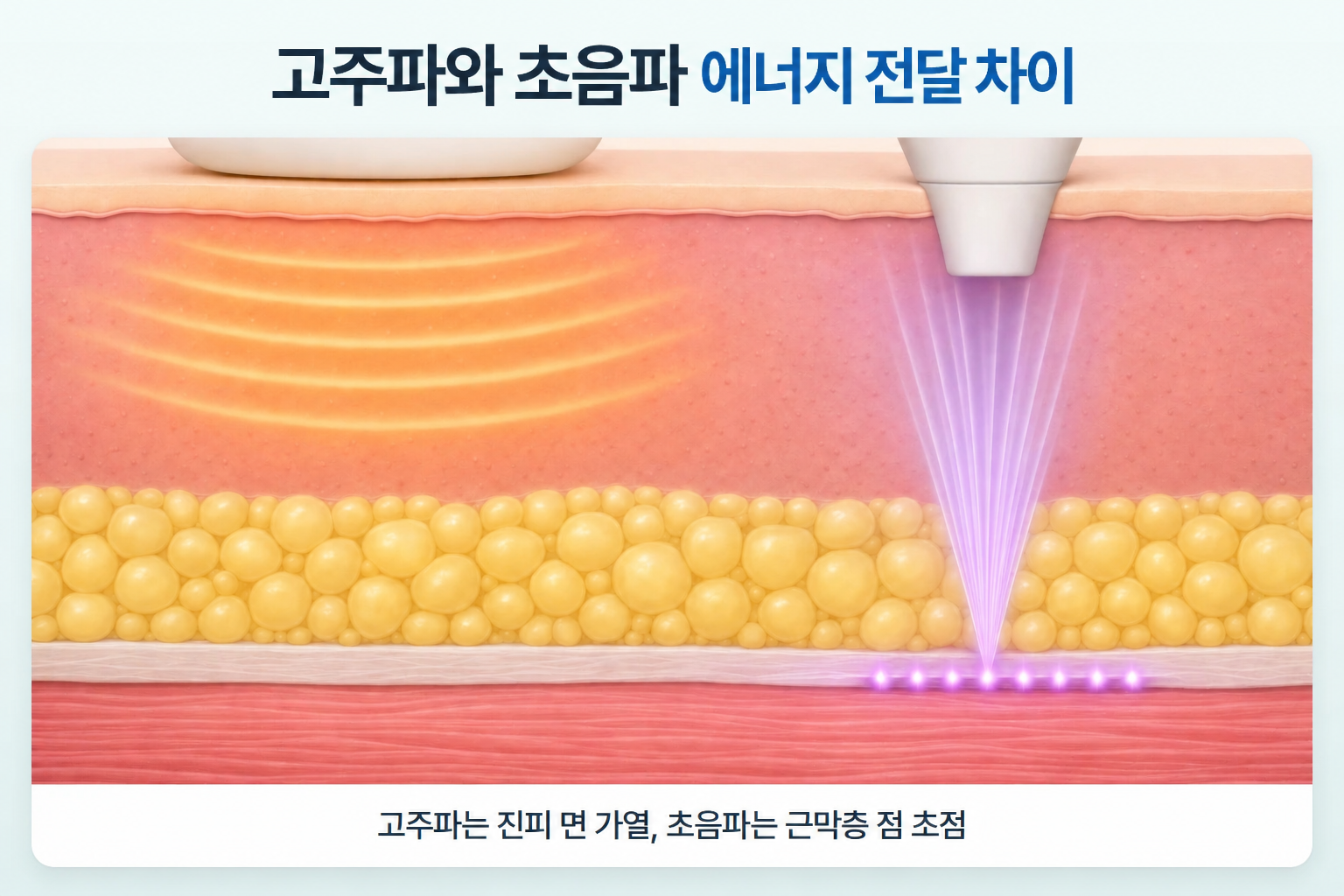 고주파의 넓은 열 전달과 집속초음파의 깊이별 점 초점 비교