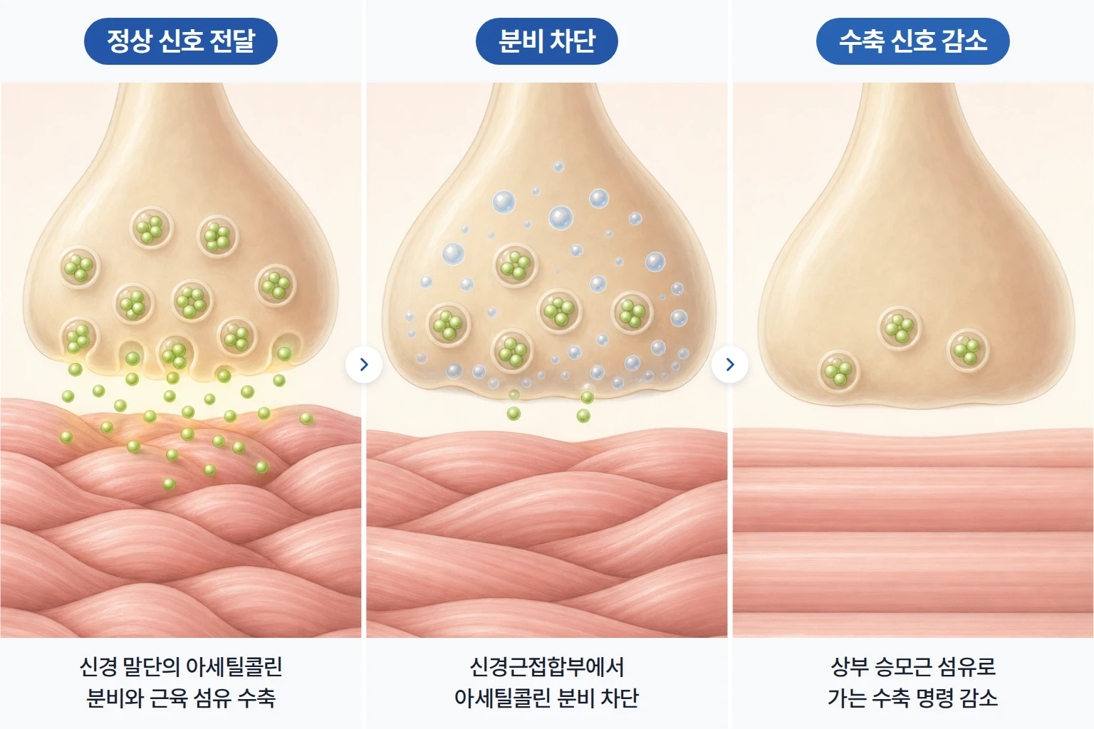 신경 말단의 아세틸콜린 분비와 차단, 승모근 섬유의 수축 신호 감소를 단계별로 나타낸 개념도