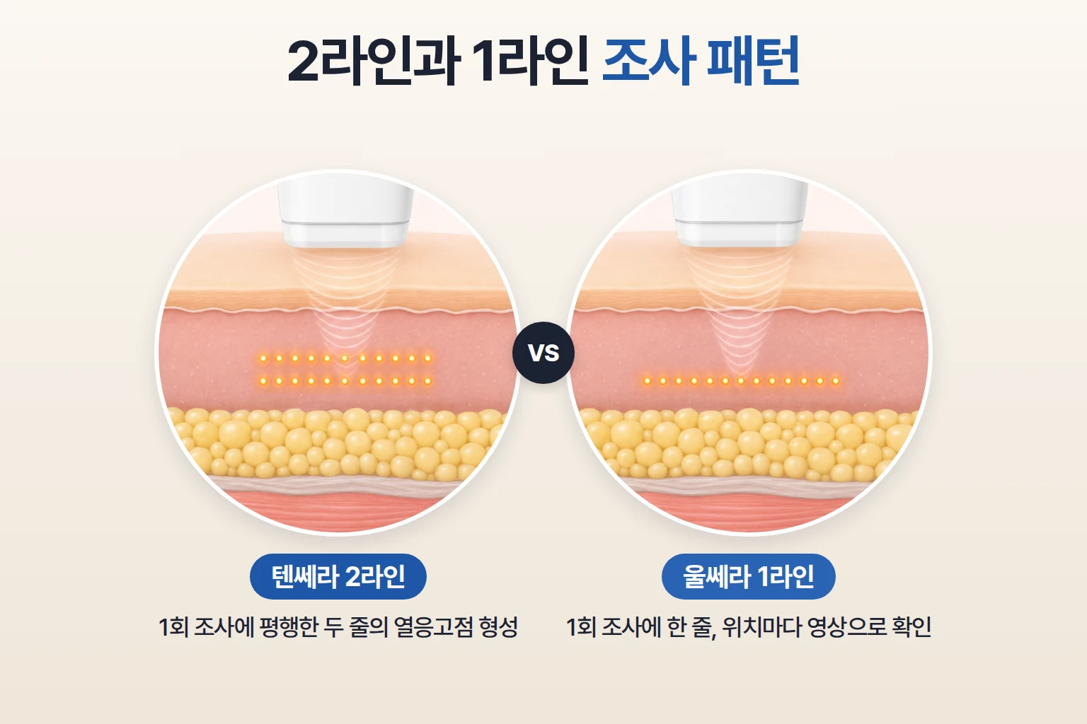 한 번 조사에 두 줄로 맺히는 텐쎄라와 한 줄로 맺히는 울쎄라 열응고점 배열을 비교한 일러스트