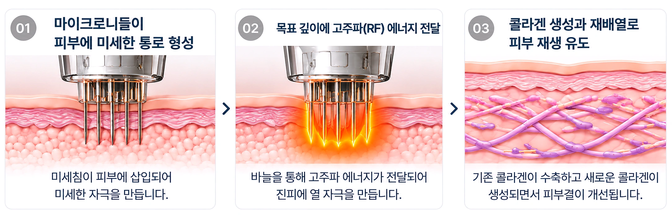 마이크로니들과 고주파 에너지를 이용한 포텐자 레이저 시술 원리
