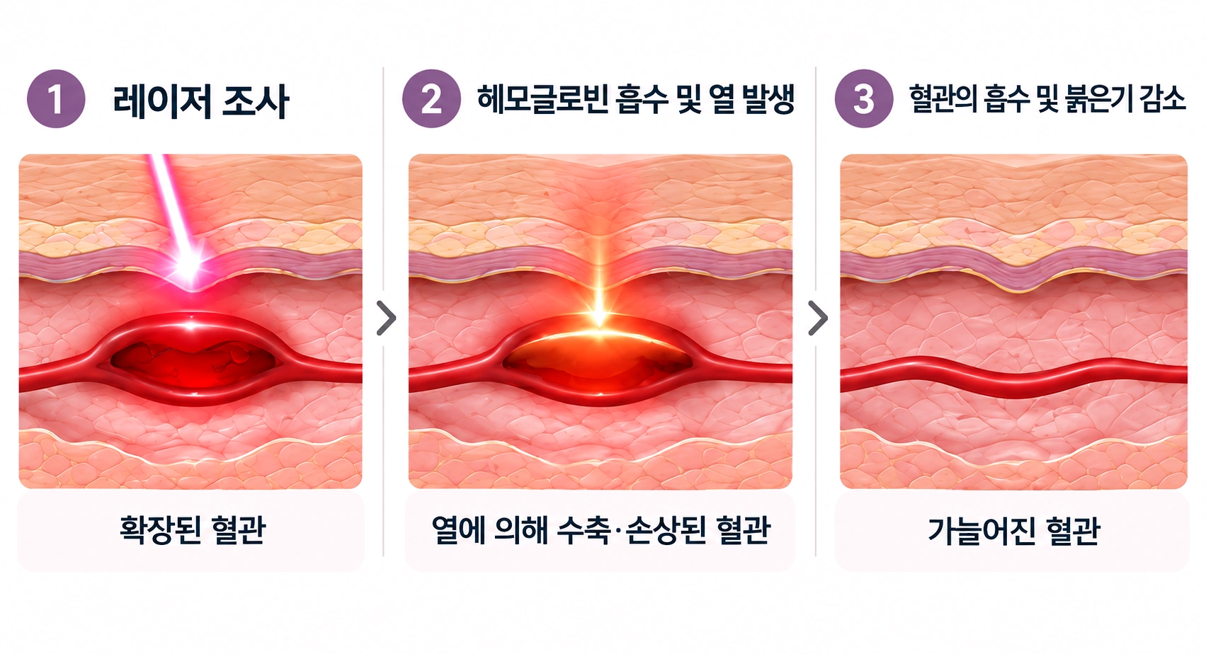 헤모글로빈에 레이저 에너지를 전달해 확장된 혈관을 줄이는 홍조 레이저 원리