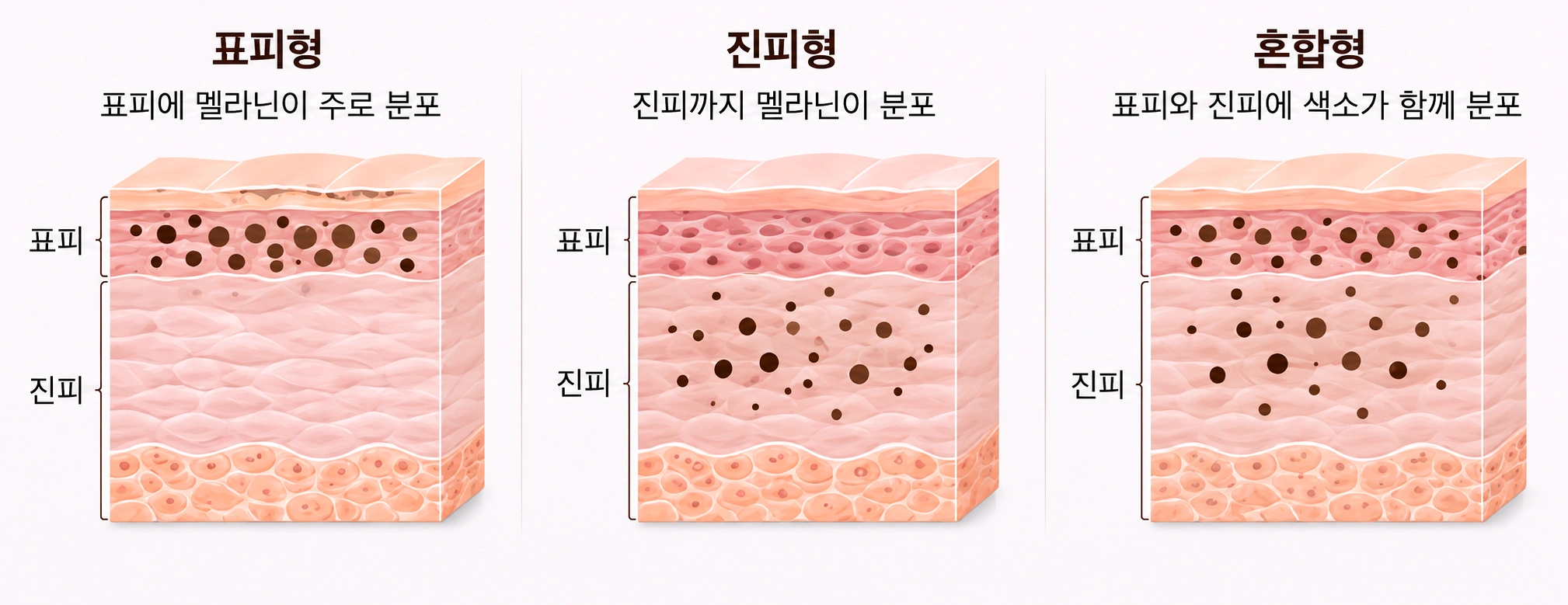 표피형·진피형·혼합형 기미의 멜라닌 색소 위치와 피부 깊이 차이를 비교한 단면도
