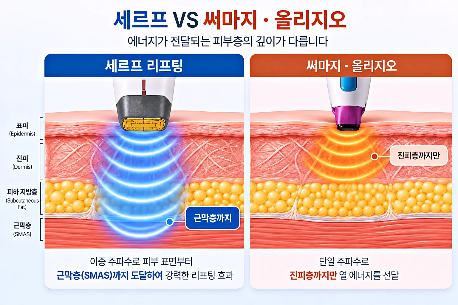 높은 주파수와 낮은 주파수의 열 도달 깊이를 동일 배율로 비교한 피부 단면 모식도