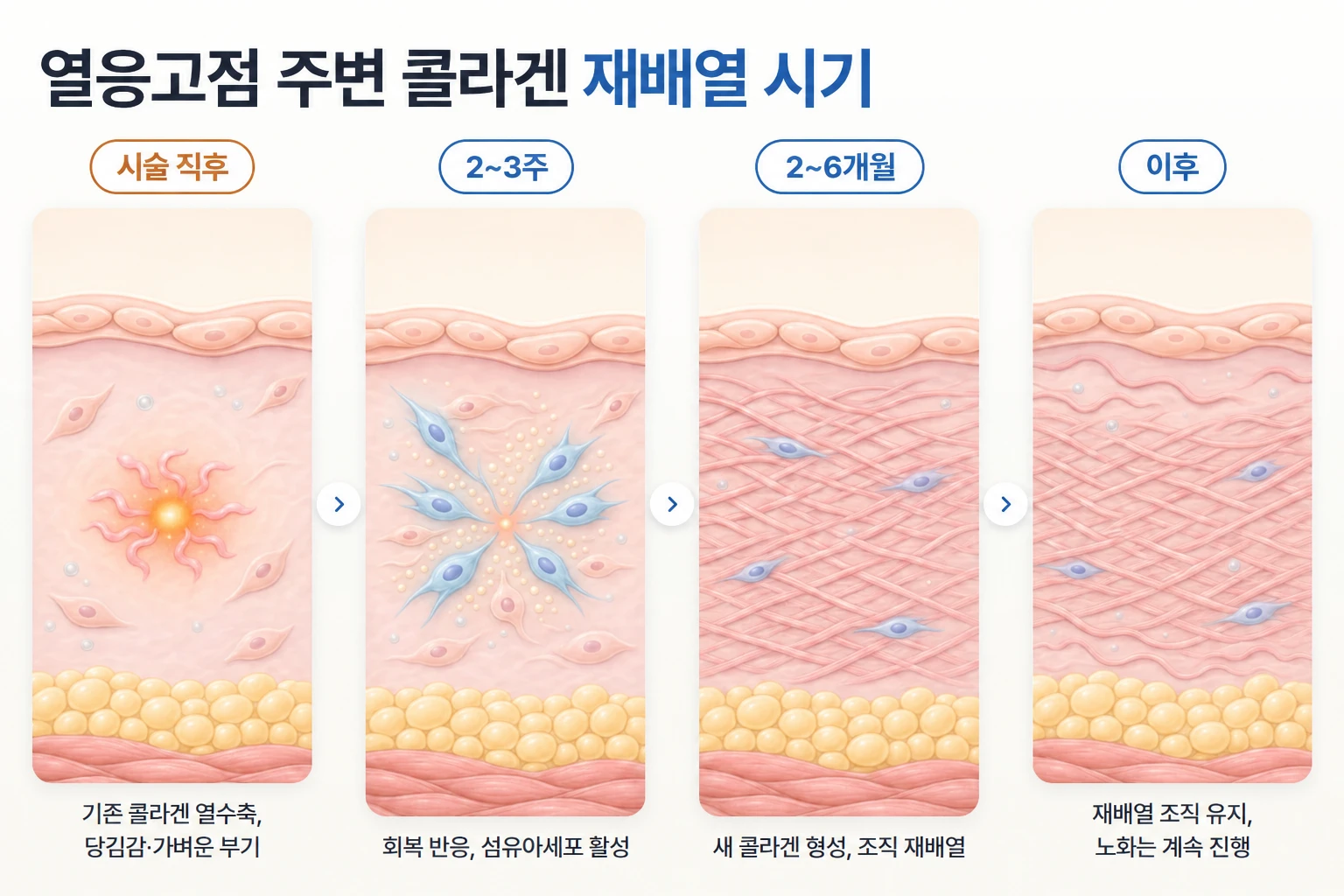 열응고점 주변 섬유아세포의 새 콜라겐 형성과 조직 재배열을 시술 직후부터 시기별로 나타낸 개념도