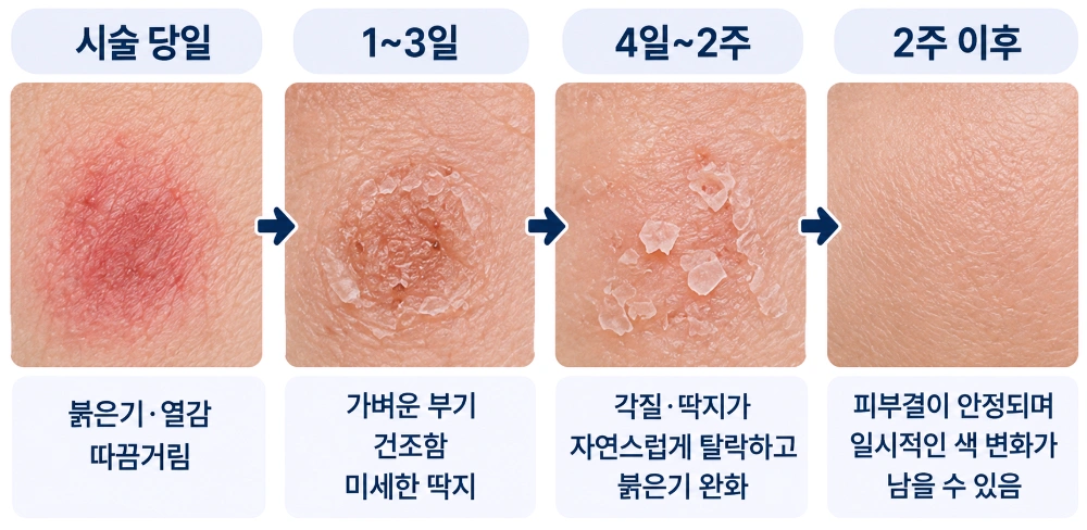 여드름흉터 치료 후 시술 당일 붉은기와 열감부터 각질과 딱지 탈락, 피부 안정까지의 회복 과정을 시기별로 정리한 피부 변화 사진