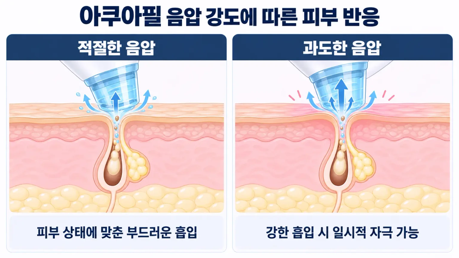 아쿠아필 음압 강도에 따른 모공 주변 피부 반응과 일시적 자극 가능성 비교