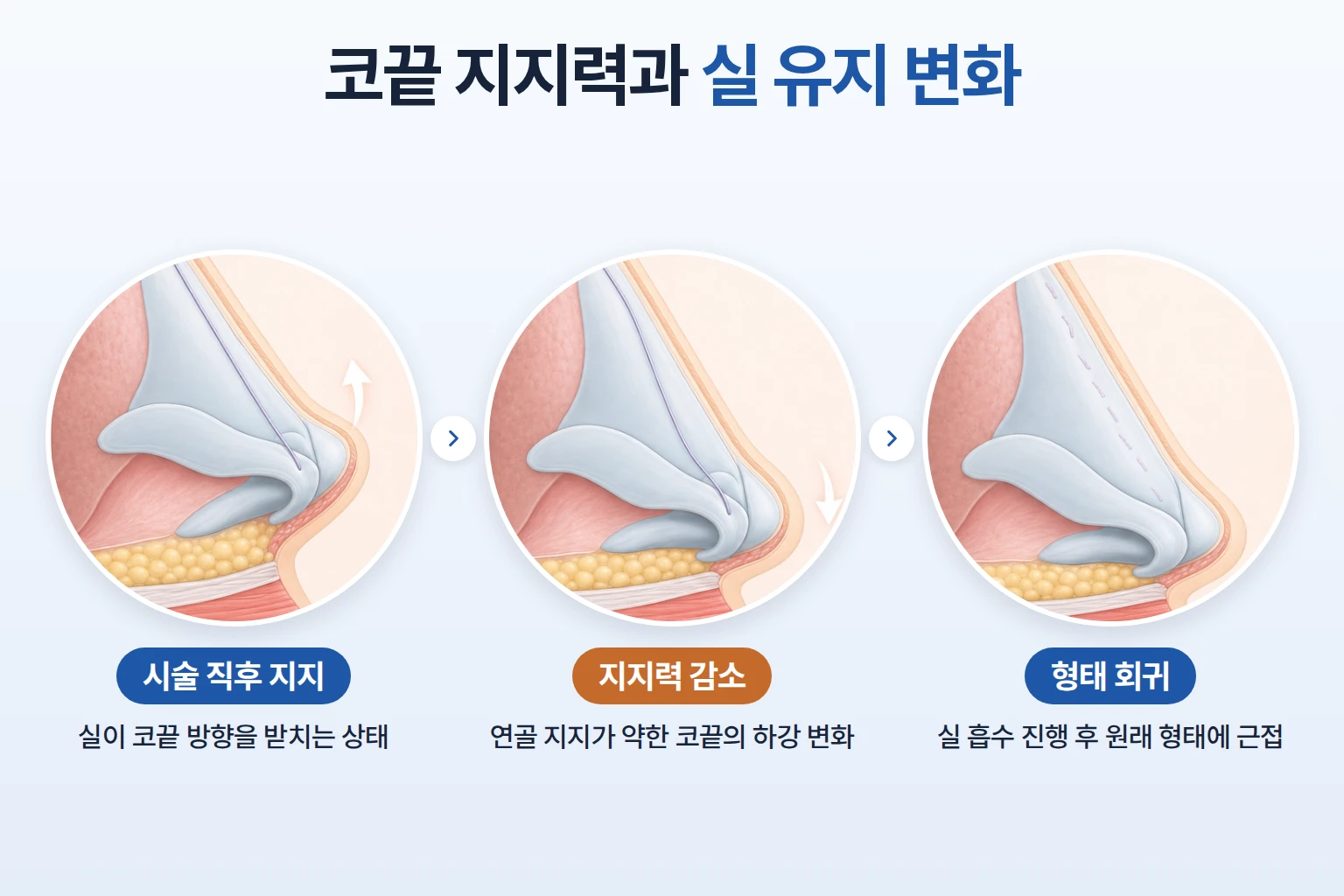 코끝 연골 지지력이 약할 때 실의 지지와 형태 변화를 단계별로 비교한 코 단면 모식도