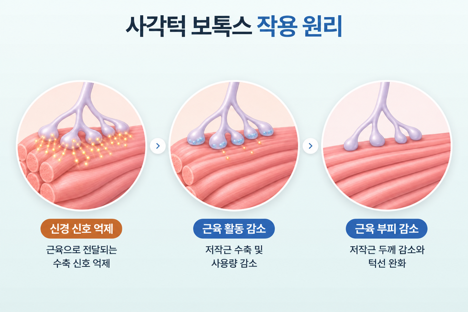 사각턱 보톡스의 신경 수축 신호 억제부터 저작근 활동 감소, 근육 두께 감소까지 이어지는 3단계 작용 원리