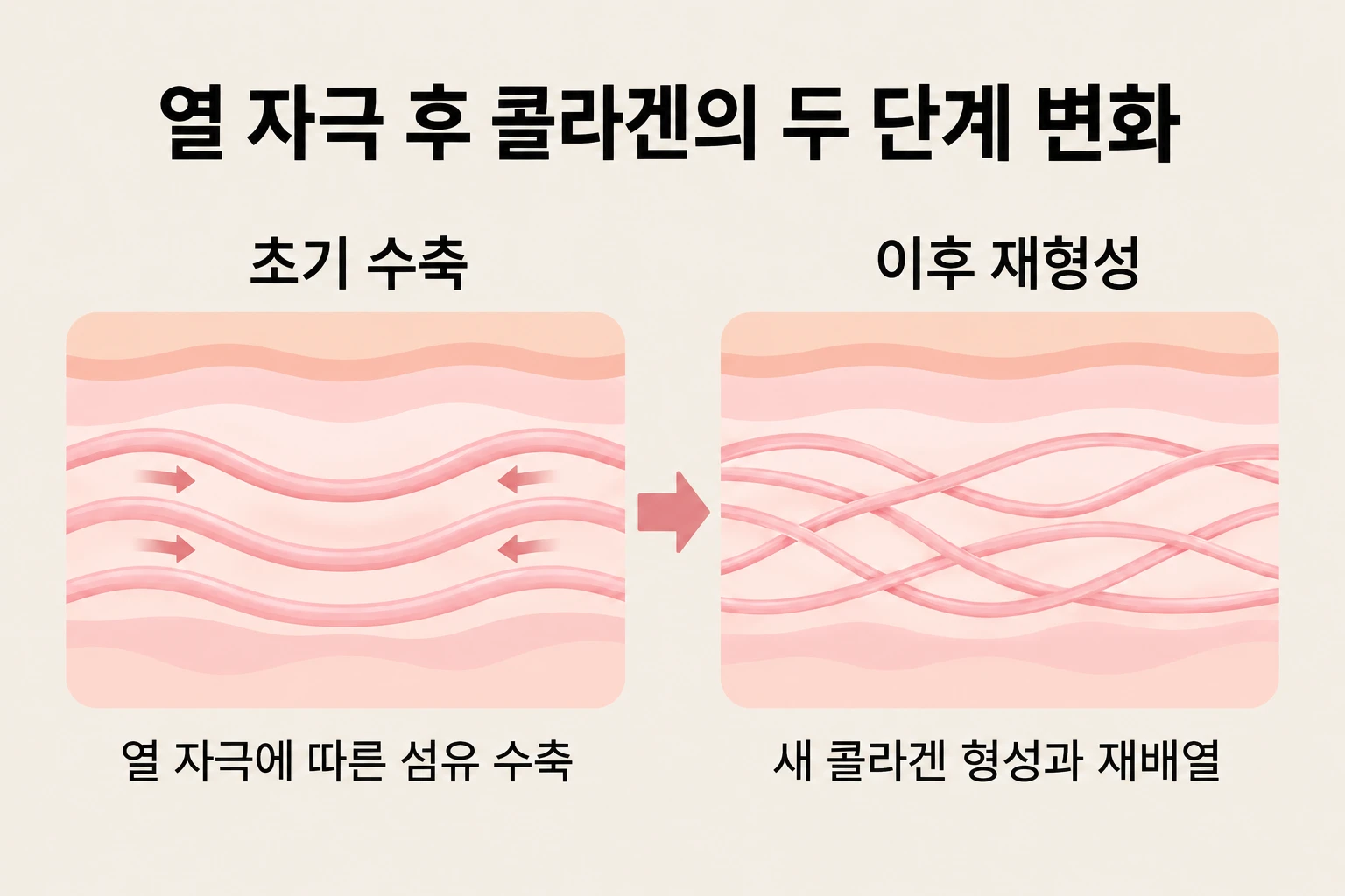 열 자극에 따른 콜라겐 섬유 수축과 이후 새 콜라겐의 형성·재배열 원리 설명 이미지