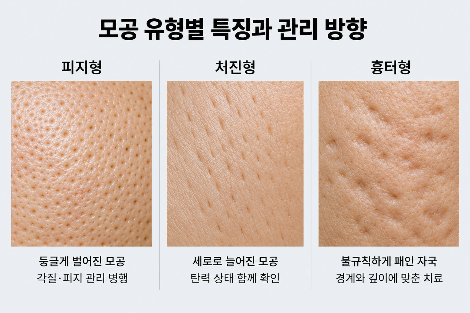 둥근 피지형 모공과 세로로 늘어진 모공, 불규칙한 흉터 자국의 특징 비교